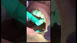 teeth cleaning at the dentist step by step #shorts