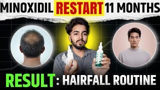 Minoxidil Restart 11 Month Hair Growth Results  | Sahil Nagpal