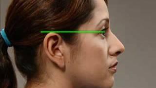 Assessing the Auricle Psition.flv