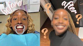 VLOG | GETTING BRACES!! and doing everything to feel cute afterwards | cheymuv