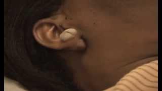 Removal Treatment of an Earlobe Keloid from right ear, New York Keloid Specialist