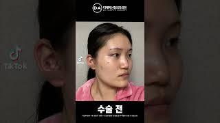 턱주가리녀? 성형 레전드 탄생 #윤곽3종후기 #눈성형후기