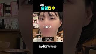 요즘 눈 성형 트렌드는 ? '무쌍눈매교정'  #성형외과 #강남성형외과 #무쌍눈매교정 #무쌍 #무쌍수술 #눈매교정 #눈매교정후기