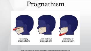 Prognathism