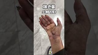 손목절단 접합수술 6개월차 #shorts #후천적왼손잡이