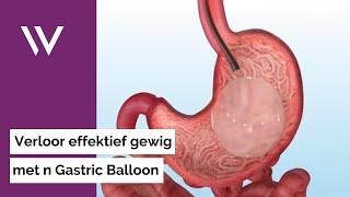 Die Maagballon prosedure: 'n Nie-indringende versneller om jou gewigsverlies doelwit te bereik.