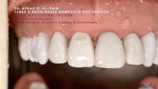 Class V composite restoration on a maxillary central incisor (#11) - Arabic عربي