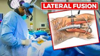 INSIDE THE OR: Lateral Lumbar Interbody Fusion (LLIF) w/percutaneous screws