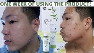 E1 ▪ HELLO GLOW ACNE DEFENSE SET  REVIEW- HONEST REVIEW IN ONE WEEK!