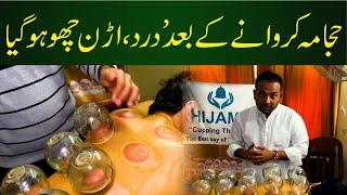 Hijama Krwaney Kay Baad Dard Uran Choo | Wet Cupping Therapy | Hijama for Skin Care