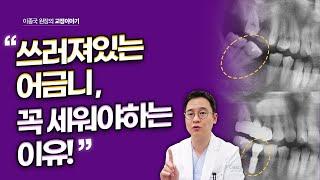 쓰러져있는 어금니를 치아교정으로 꼭 세워야 하는 이유! (molar uprighting)