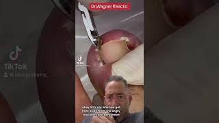 EXTRACTION OF INGROWN NAIL SPICULE#shorts