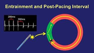 Entrainment Mapping: The Post-Pacing Interval