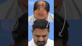 ⭐India's Best Hair Transplant Clinic | #shorts #shortsfeed #besthairtransplantresults