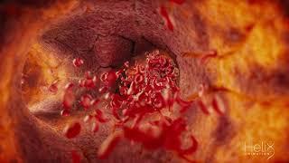 3D animation of a Clogged blood vessel due to a Sickle cell disease