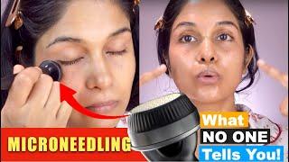 Microneedling at Home? Here is what You Should Know (Banish Microneedle)
