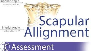 Scapular Alignment and possible causes for dyskinesia