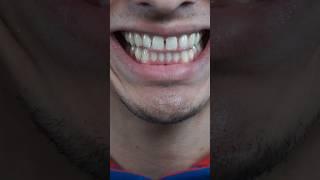 My Full Braces Journey… so far 