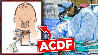 Anterior Cervical Discectomy and Fusion (ACDF)