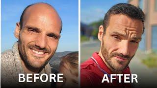 Hair Transplant Results after 1 Year - Hairneva / Dr Go (Istanbul, Turkey) - Ben Heine