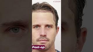 Former England Cricketer Hair Transplant Before and after Results at Eugenix Hair Sciences Clinic