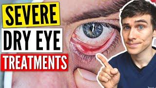 Severe Dry Eyes Treatment - Dry Eyes Treatment Guide