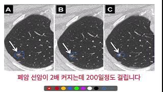 폐결절!! -by 호흡기내과의사.