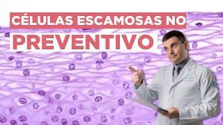 Células Escamosas no Preventivo. Devo me preocupar?