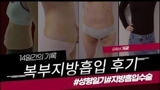 복부지방흡입후기 뱃살 뚱뚱녀의 14일간의 기록!