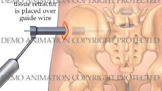 Sacroiliac Joint Fusion by Trial FX Medical Animations