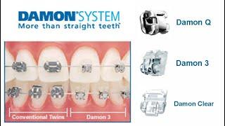 Damon Clear Braces จัดฟันดามอน | www.bangkokbraces.com