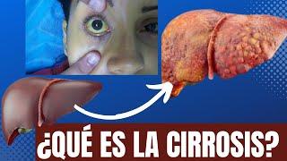 ¿Qué es la cirrosis de hígado?