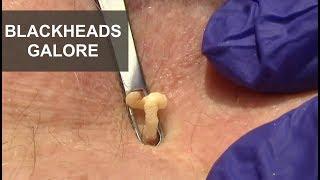 Blackheads Galore | Dr. Derm