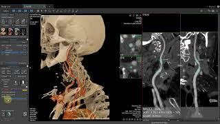 Vitrea Demonstrations  |  Vessel Stenosis Quantification