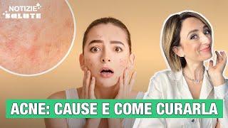 Acne: quali sono le cause e come si può curare?