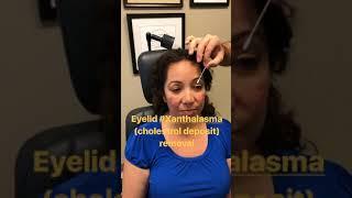 Eyelid Xanthalasma Cholesterol Deposit Removal with Blepharoplasty