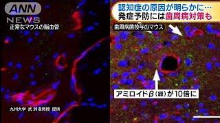 認知症の原因が明らかに　発症予防には歯周病対策を(2020年10月13日)