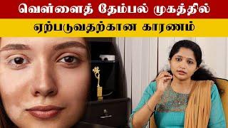 How To Control White Patches Tamil | வெள்ளைத் தேம்பல் குணப்படுத்துவது எப்படி?