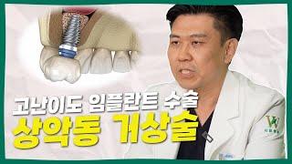 임플란트 수술 중 난이도 최상! 상악동 거상술!