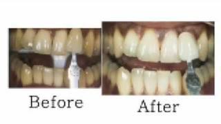 Chicago Teeth Whitening