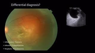 An approach to Leucocoria: Ophthalmology MSc taster lecture