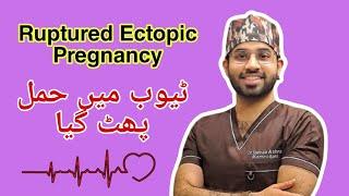 Ectopic Pregnancy| Tube Main Haml Phat Gya|Dr Hamza Ashraf