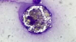 Mammary Foam cells with Lipid laden macrophages | mammary cytology