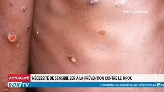 Nécessité de sensibiliser à la prévention contre le Mpox