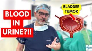 Blood In Urine | Bladder Cancer Treatment LIVE !