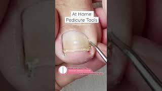 At Home Ingrown Toenail Relief