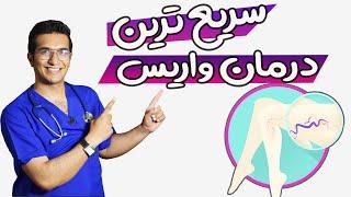 درمان واریس | varicose veins treatment