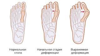 Как убрать косточки на больших пальцах ступней! Кирилл Вершилов Аврора