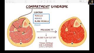 Fundamentals of Orthopaedics Session 14 Part 2 - Compartment Syndrome