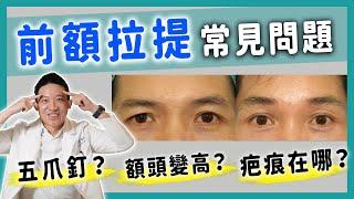 內視鏡額拉很痛嗎？提眉=額拉？可同時縫雙眼皮？會禿頭？眉壓眼就能做嗎｜新聖整形外科 林子宇醫師